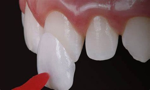 Facetas ou Lente de contato, qual a melhor escolha?