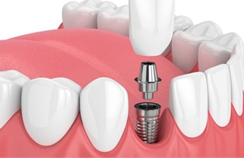 Implantes